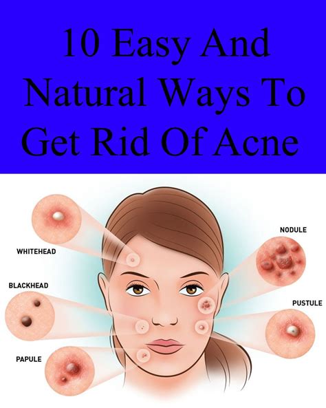 10 Easy And Natural Ways To Get Rid Of Acne How To Get Rid Of Acne