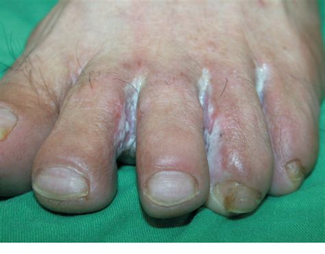 Intertrigo refers to a type of inflammatory rash of the superficial skin that occurs within a person's body folds.1 these areas are skin affected by intertrigo is more prone to infection than intact skin.1. PDF Foot bacterial intertrigo mimicking interdigital ...