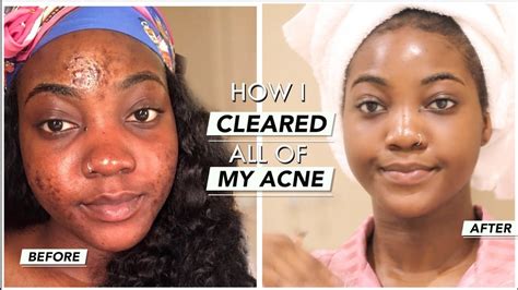 How I Cleared Up My Acneacne Scars Skincare Journey Youtube