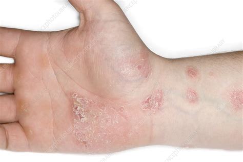 Psoriasis Of The Hand Stock Image C0234343 Science Photo Library