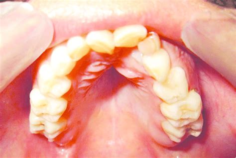 Intra Oral Photograph Of Patient 1 Showing High Arched Palate