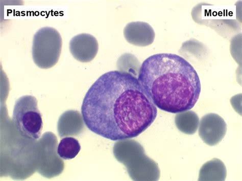 Plasmocytes Vs Lymphocytes Medical Laboratory Science Hematology