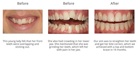 Are your teeth crooked or do you have an overbite or underbite? Teeth Straightening Fareham | Child Braces | Adult ...