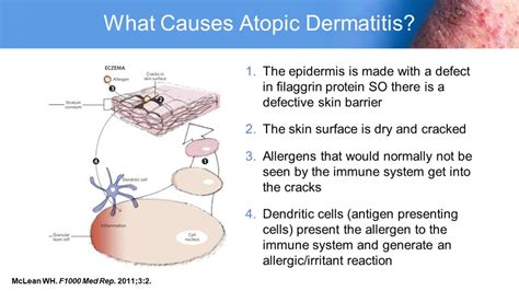 Atopic Dermatitis Improving Outcomes In Adult And Pediatric Patients