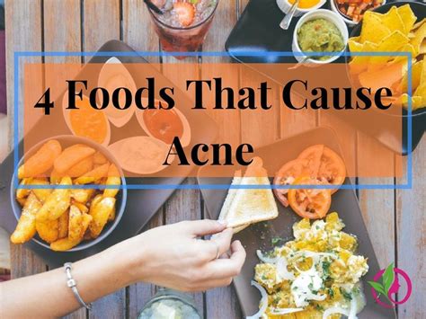 Want To Know What Foods Cause Acne These 4 Foods Might Be The Cause Of