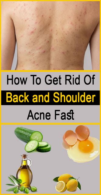 How To Get Rid Of Back And Shoulder Acne Fast Beauties Natural