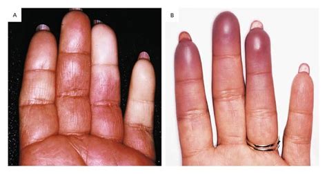 Raynauds Phenomenon Nejm