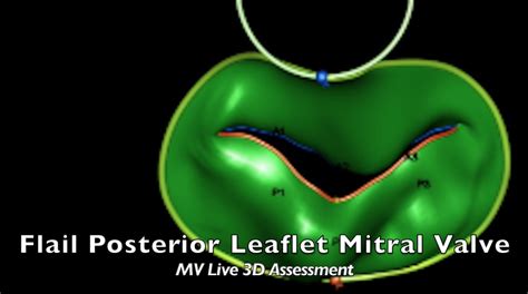 Flail Posterior Leaflet Mitral Valve Vm Live 3d Assessment Echovision