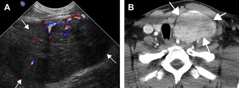 Ultrasonography Of Cervical Lymph Nodes Radiologic Clinics