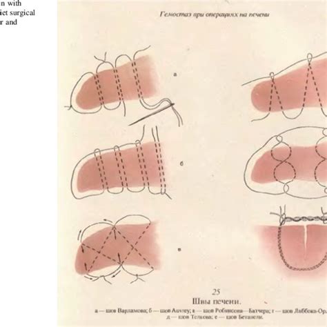 Liver Resection With Suture Lines From Soviet Surgical Atlas From