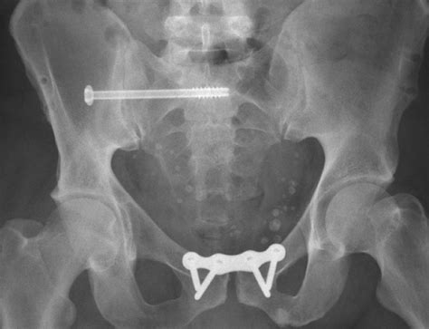 Open Reduction And Internal Fixation Of A Traumatic Diastasis Of The