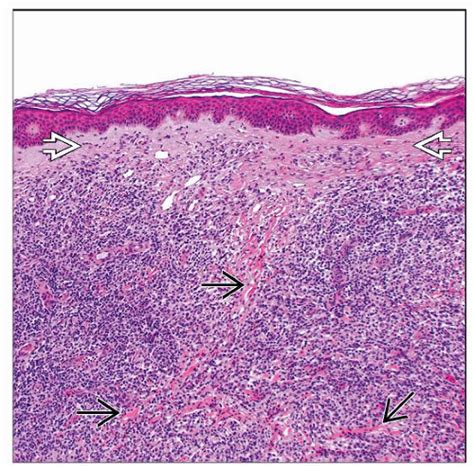 Cutaneous Marginal Zone B Cell Lymphoma Basicmedical Key