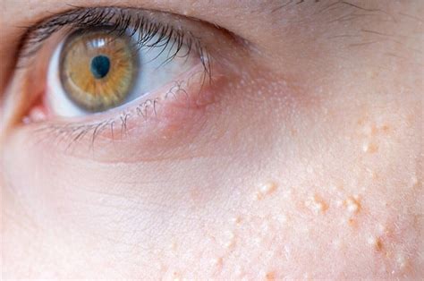 What Is Milia And Syringoma And The Best Ways On How To Treat Them