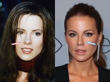 Kate Beckinsale Plastic Surgery Transformation - Before ...