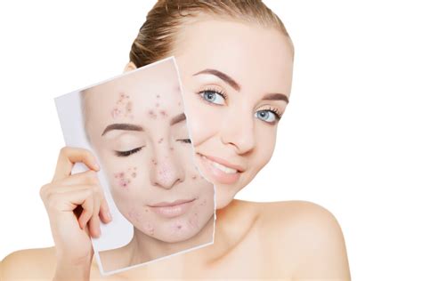 Acne And Acne Scars Skinone Vancouver Bc