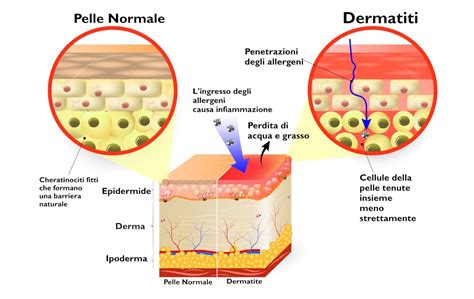 Dermatiti Quali Sono I Tipi Di Dermatite Le Cause E Le Cure