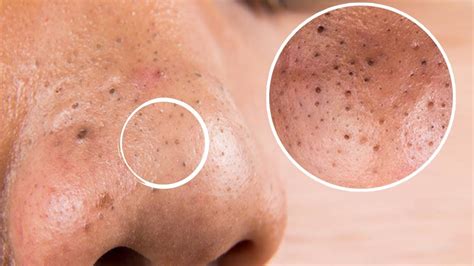 How To Remove Blackheads On The Nose Best Way To Get Rid Of