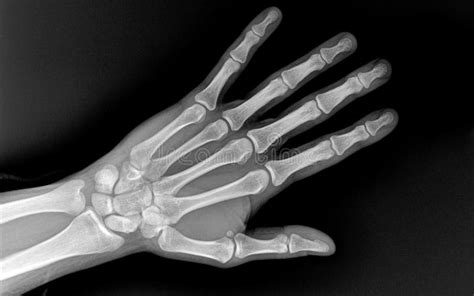 X Ray Of Healthy Whole Bones Of The Hand Close Up Stock Photo Image