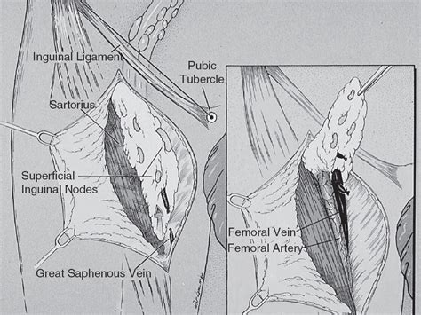 Sentinel Lymph Node Dissection