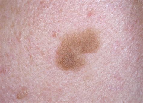 Light Brown Moles Appearing
