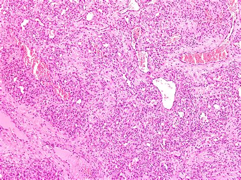 Pathology Outlines Hemangioma And Variants