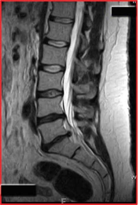 Sometimes the disc herniation happens exactly in the middle of the disc and beneath this ligament (image here) (1). S1 Radiculopathy