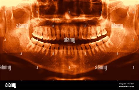 Full Arch Wide Maxillary Male Dental Panoramic X Ray Radiography Stock