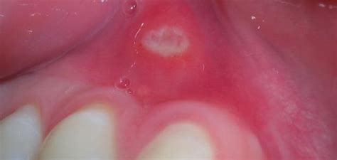 White Spots On The Gums