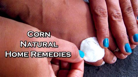 Corn Treatment With Home Remedies By Sachin Goyal Youtube