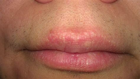 Small White Bumps On Upper Lip