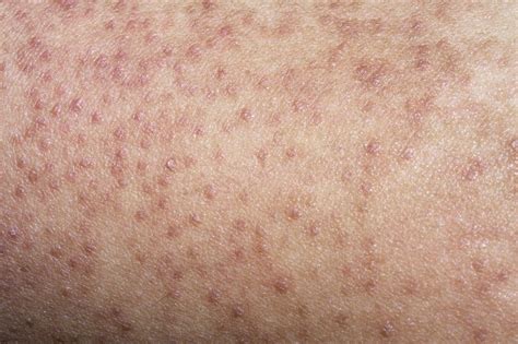 Keratosis Pilaris NHS