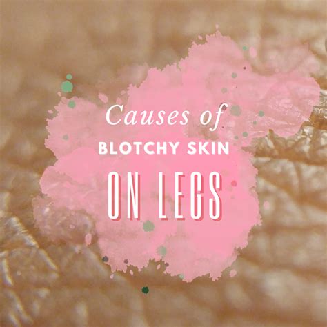 What Causes Blotchy Skin On Legs Youmemindbody