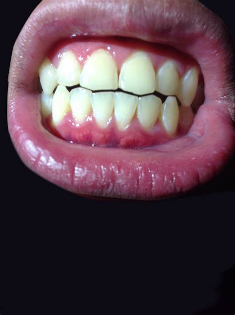 Is This Normal For Gums Dentistry