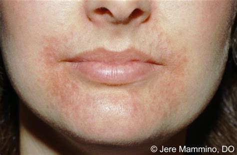 Mild Eczema Around Mouth