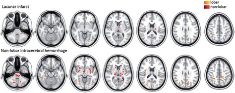 Distribution Of Cerebral Microbleeds In Patients With Lacunar Stroke Or