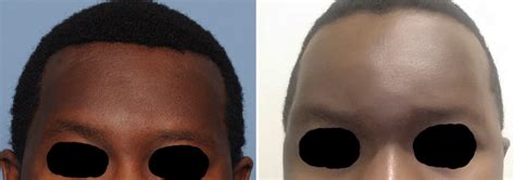 Plastic Surgery Case Study Transcoronal Temporal Reduction For Head