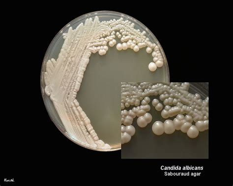 Manejo De La Infección Por Candida En El Recién Nacido Odontovida