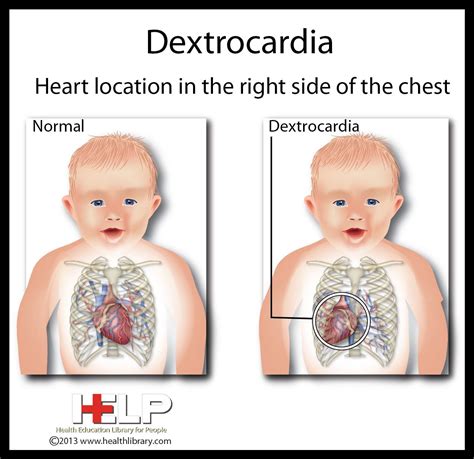Dextrocardia Medical School Studying Medical Field Congenital Heart