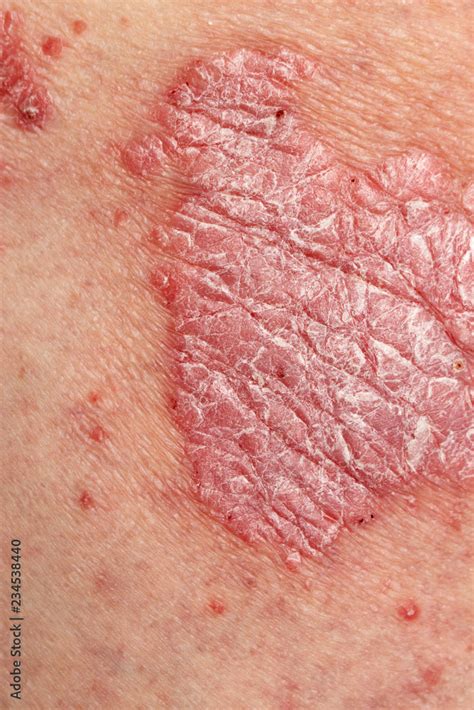 Psoriasis Vulgaris Detail Of Psoriatic Skin Disease An Autoimmune