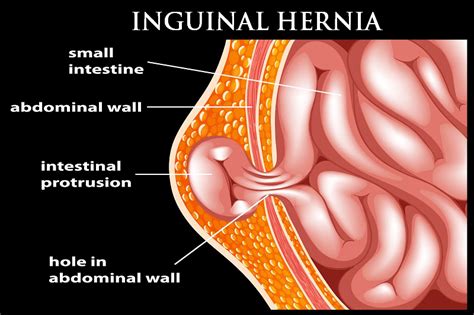 Direct And Indirect Inguinal Hernia