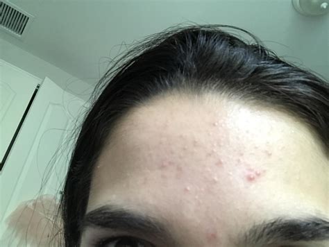 Acne Hello Ive Had These Bumps On My Forehead For Months Now I Don