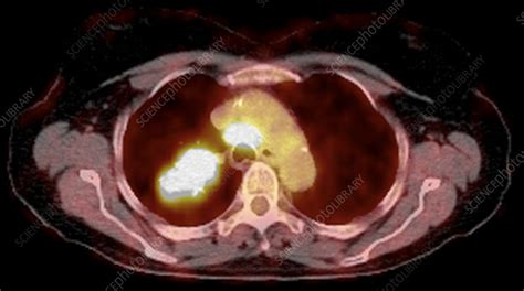 Lung Cancer CT And PET Scans Stock Image C010 3488 Science Photo