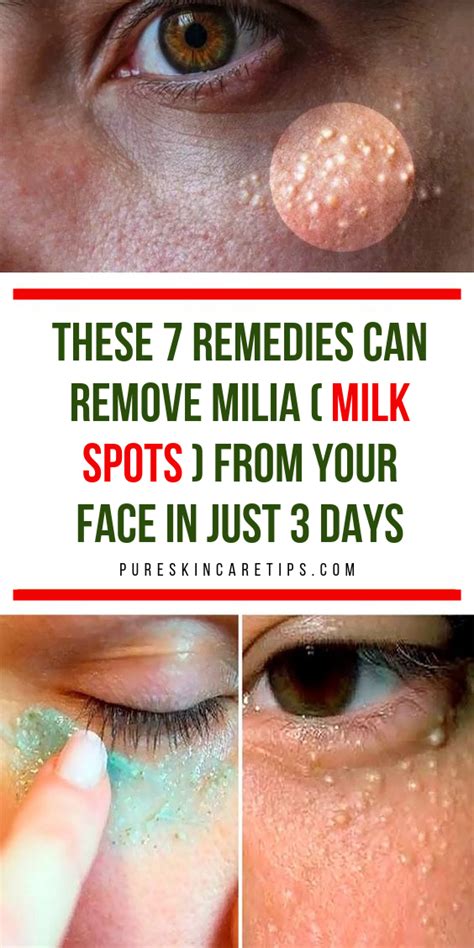 Get Rid Of Milia Fast With These 7 Home Remedies Skin Care Tips