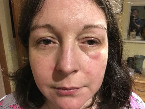 Swelling Eye Swollen Eyes Punch In The Face Hashimotos Disease