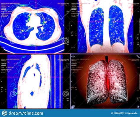 Selective Focus Of Ct Chest Or Lung 3d Rendering Image On The Monitor