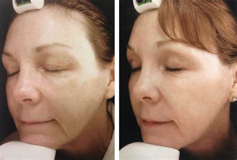 Fractional Laser Treatments In Oakland County Mi Face Beauty Science