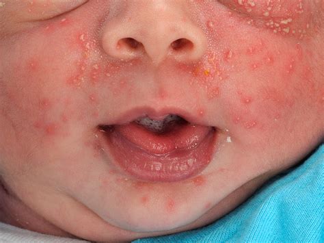 Get 19 Eczema Rash On Baby Chest