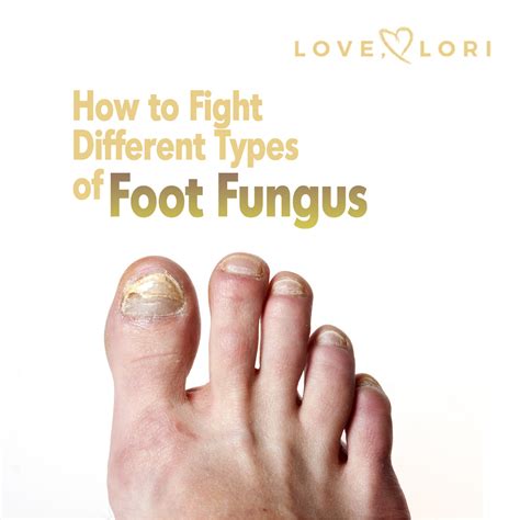 Types Of Foot Fungus And How To Fight Them At Home Love Lori