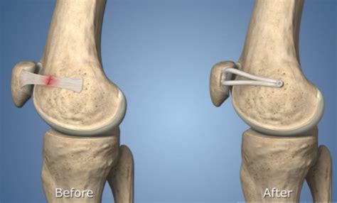 Patellar Dislocation Unstable Kneecap Treatment