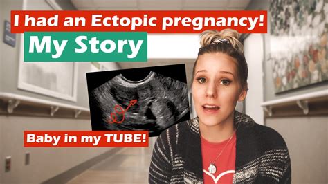 My Ectopic Pregnancy Story Youtube